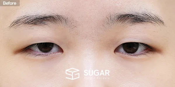 슈가성형외과 첫) 자연유착 + 눈매교정 + 윗트임 + 눈 두덩이 지방 제거 전후사진 - 수술 전