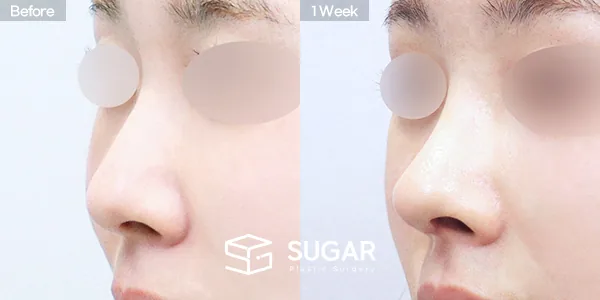 슈가성형외과 첫) 콧대 + 코끝 + 무보형물 + 비중격연골 + 귀연골 + 매부리 + 복코+ 휜코 + 귀 뒤 근막 전후사진 - 45도 수술 전후 비교