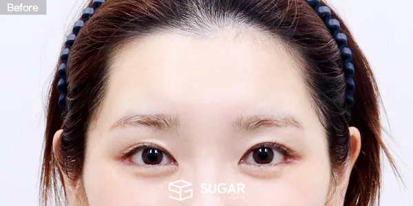 슈가성형외과 첫) 이마거상 전후사진 - 전후 비교 사진