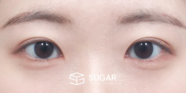 슈가성형외과 첫) 자연유착 + 눈매교정 + 윗트임 전후사진 - 수술 후