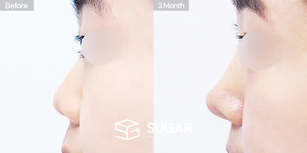 슈가성형외과 첫) 콧대 + 코끝 + 귀연골 + 복코 + 짧은코 + 매부리 전후사진 - 측면 수술 전후 비교