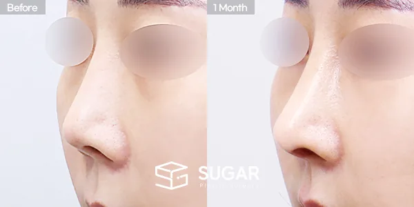 슈가성형외과 재) 재수술 + 콧대 + 코끝 + 기증늑 + 비중격연장 + 절골 전후사진 - 45도 수술 전후 비교