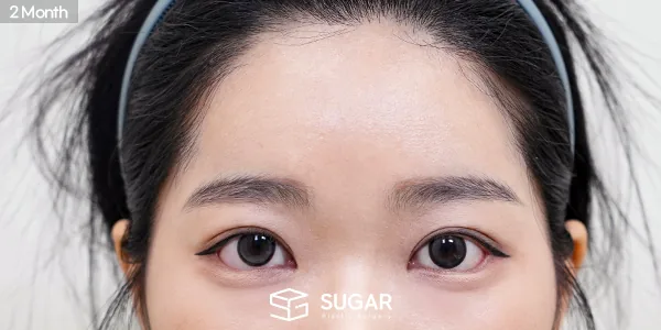 슈가성형외과 재) 절개 재수술+ 눈매교정 + 뒤밑트임 재수술 + 이마거상 전후사진 - 수술 후