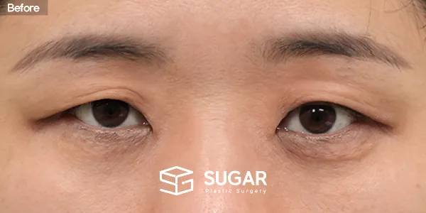 슈가성형외과 첫) 눈썹 거상 + 자연유착 + 윗트임 전후사진 - 수술 전