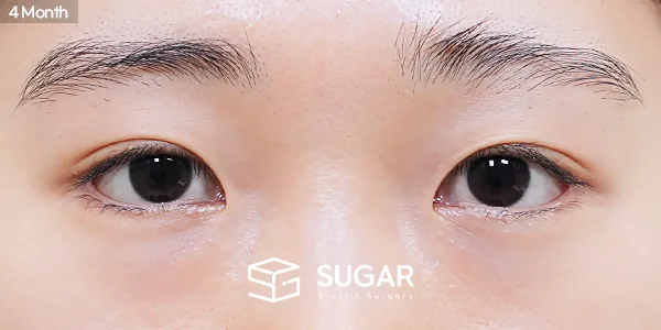 슈가성형외과 재) 재수술 + 뒤밑트임 전후사진 - 수술 후
