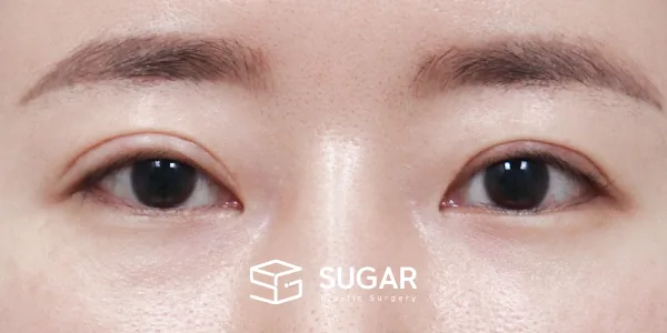 슈가성형외과 재) 재수술 + 자연유착 + 윗트임[L] + 뒤밑트임 전후사진 - 수술 전