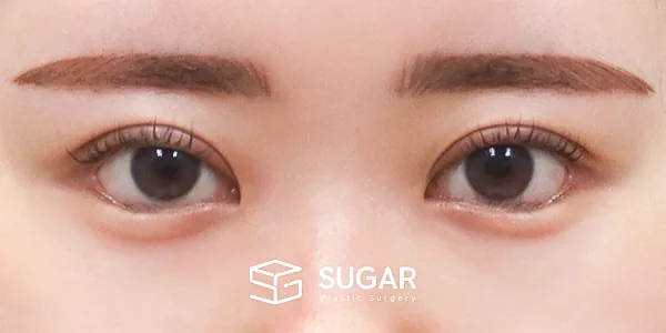 슈가성형외과 첫) 자연유착 + 눈매교정 + 뒤밑트임 전후사진 - 수술 후