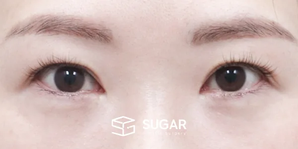 슈가성형외과 재) 재수술 + 상안검 + 뒤밑트임 전후사진 - 수술 전