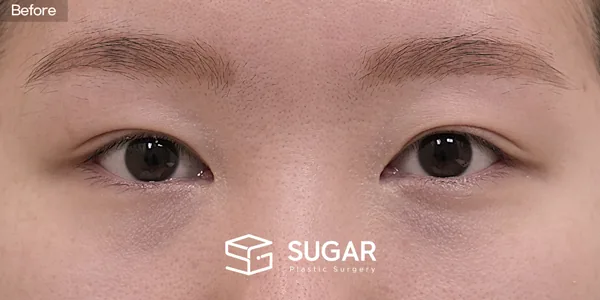 슈가성형외과 첫) 비절개눈매교정 + 윗트임 전후사진 - 수술 전