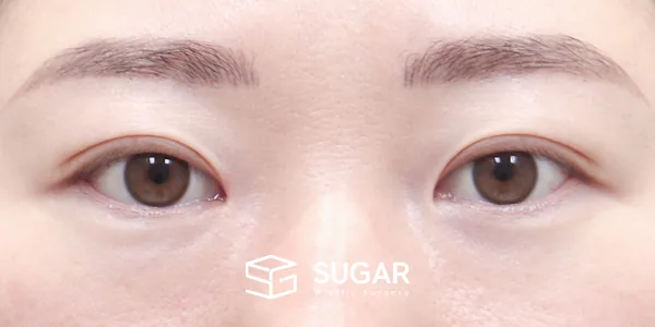 슈가성형외과 첫) 절개 + 윗트임 전후사진 - 수술 후