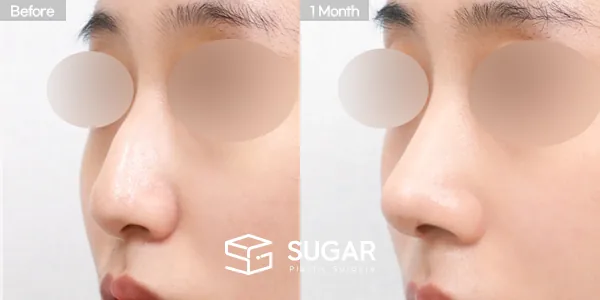 슈가성형외과 첫) 코끝 + 매부리코 + 휜코 전후사진 - 45도 수술 전후 비교
