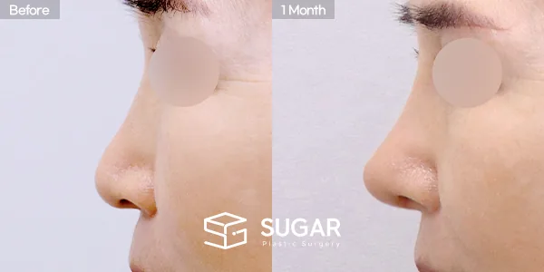 슈가성형외과 첫) 콧대 + 코끝 + 귀연골 + 비중격연골 + 복코 전후사진 - 측면 수술 전후 비교