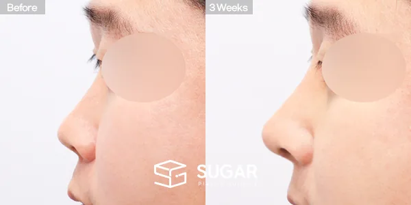 슈가성형외과 첫) 콧대 + 코끝 + 매부리코 + 귀연골 전후사진 - 측면 수술 전후 비교