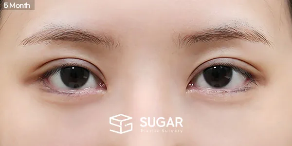 슈가성형외과 첫) 비절개눈매교정 + 윗트임 + 웨이브뒤밑트임 전후사진 - 수술 후