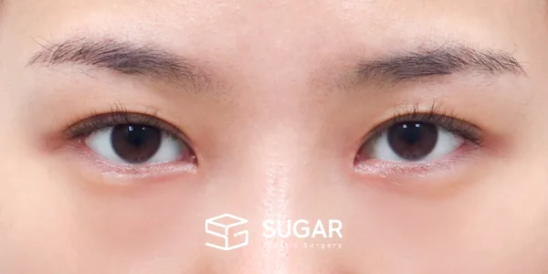 슈가성형외과 첫) 자연유착 + 눈매교정 + 윗트임 전후사진 - 수술 후