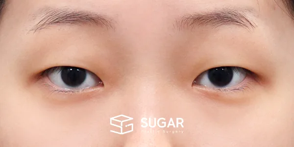 슈가성형외과 첫) 자연유착 + 눈매교정 + 앞트임 전후사진 - 수술 전