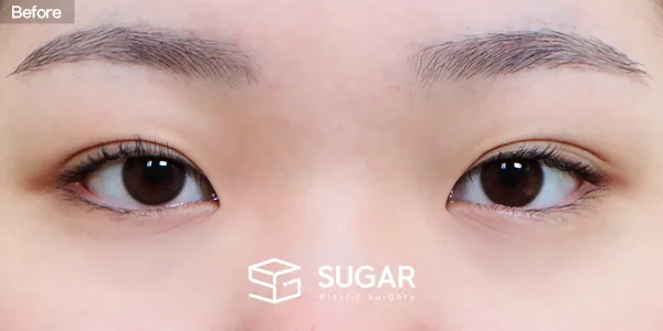 슈가성형외과 첫) 자연유착 + 눈매교정 + 앞트임 + 윗트임 전후사진 - 수술 전