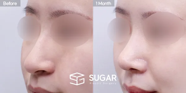 슈가성형외과 첫) 코끝+매부리코+휜코+복코+절골+비중격 전후사진 - 45도 수술 전후 비교