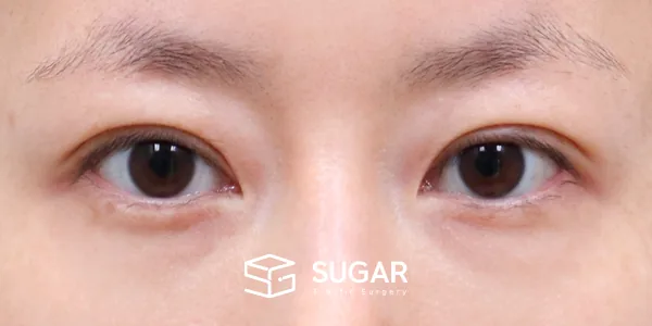 슈가성형외과 재) 재수술 + 자연유착 전후사진 - 수술 후