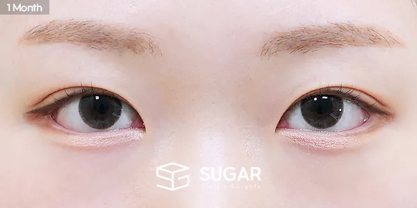 슈가성형외과 재) 재수술 + 뒤밑트임 전후사진 - 수술 후