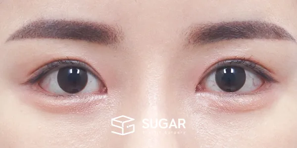 슈가성형외과 재) 재수술 + 절개(두 줄 따기) + 뒤밑트임 전후사진 - 수술 후