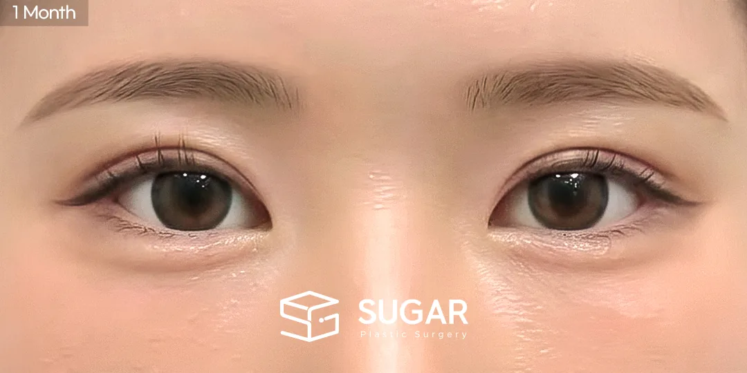 슈가성형외과 첫) 비절개눈매교정 + 앞트임 전후사진 - 수술 후