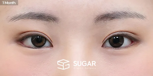 슈가성형외과 첫) 절개 + 눈매교정 + 앞트임 + 뒤밑트임 전후사진 - 수술 후
