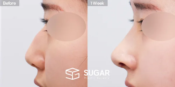 슈가성형외과 첫) 코끝 + 매부리코 + 무보형물 코성형 + 절골 + 귀 뒤 근막 전후사진 - 측면 수술 전후 비교