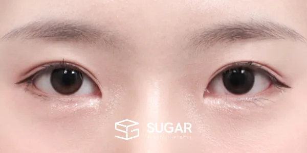 슈가성형외과 첫) 절개 + 앞트임 + 윗트임 + 뒤밑트임 전후사진 - 수술 후