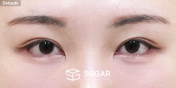 슈가성형외과 첫) 뒤밑트임 + 눈밑지방재배치 전후사진 - 수술 후