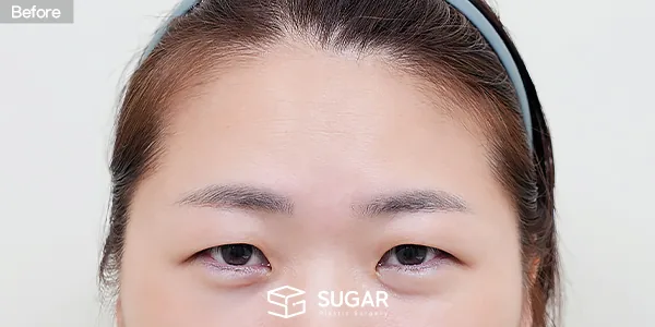 슈가성형외과 첫) 이마거상 + 자연유착 + 눈 두덩이 지방 제거 + 윗트임 + 뒤밑트임 전후사진 - 수술 전