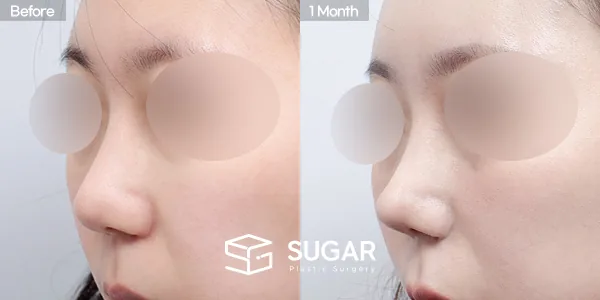 슈가성형외과 첫) 무보형물+절골+복코+귀연골 전후사진 - 45도 수술 전후 비교