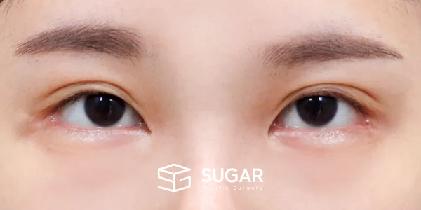 슈가성형외과 첫) 절개(두 줄 따기) + 눈매교정 + 2Point 뒤밑트임 전후사진 - 수술 전