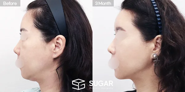 슈가성형외과 첫) 중안면부거상 + 풀페이스 지방이식 + 이중턱 지방흡입 + 실리프팅 전후사진 - 전후 비교 사진
