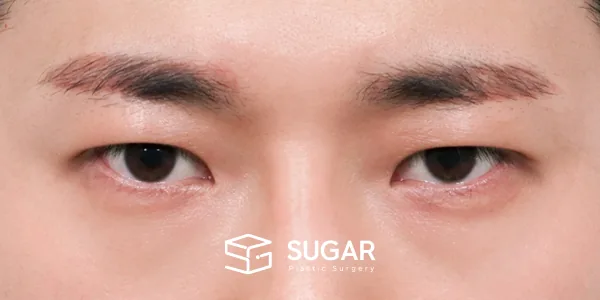 슈가성형외과 첫) 자연유착 + 눈매교정 전후사진 - 수술 후