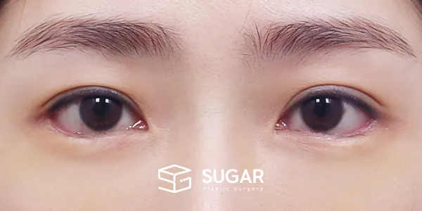 슈가성형외과 첫) 눈 밑 지방재배치 + 뒤밑트임 전후사진 - 수술 후