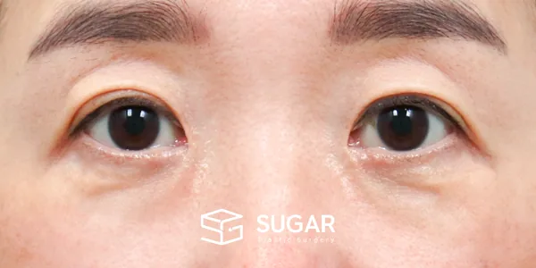 슈가성형외과 첫) 중안면부 거상 + 하안검 전후사진 - 수술 전