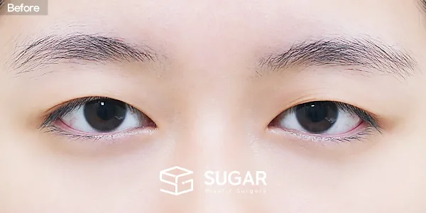 슈가성형외과 첫) 자연유착 + 눈매교정 전후사진 - 수술 전