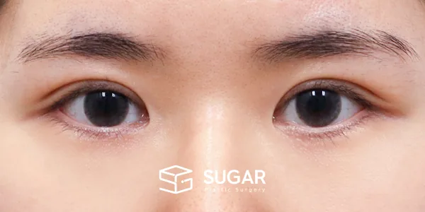 슈가성형외과 재) 재수술 + 절개 전후사진 - 수술 후
