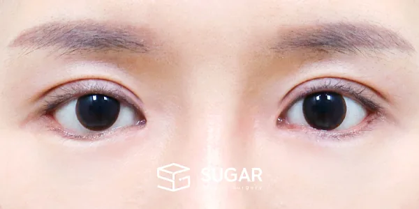 슈가성형외과 재) 절개 재수술 + 눈 두덩이 지방재배치 + 윗트임 + 앞트임 + 뒤밑트임 전후사진 - 수술 후