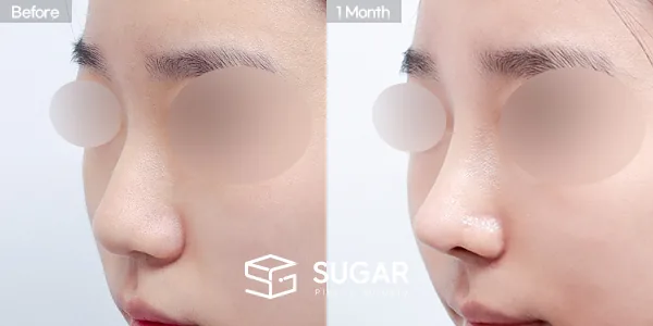 슈가성형외과 첫) 콧대+코끝+절골+콧대다듬기+복코+기증늑 전후사진 - 45도 수술 전후 비교