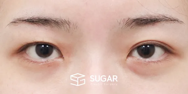 슈가성형외과 첫) 절개 + 앞트임 + 뒤밑트임 전후사진 - 수술 전
