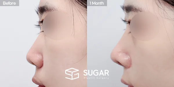 슈가성형외과 첫) 콧대+비중격연장+짧은코+코선반교정+귀연골 전후사진 - 측면 수술 전후 비교