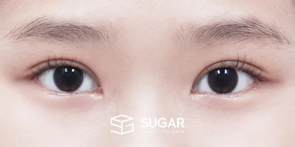 슈가성형외과 첫) 자연유착 + 눈매교정 전후사진 - 수술 후