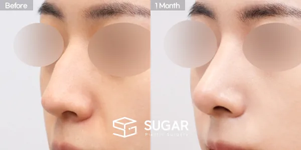 슈가성형외과 첫) 코끝 + 매부리코 + 무보형물 코성형 + 절골 + 귀 뒤 근막 전후사진 - 45도 수술 전후 비교