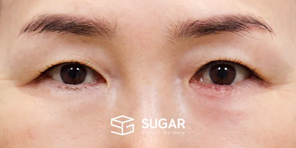슈가성형외과 첫) 눈썹 거상 + 자연유착 + 눈 위 지방 제거 전후사진 - 수술 전