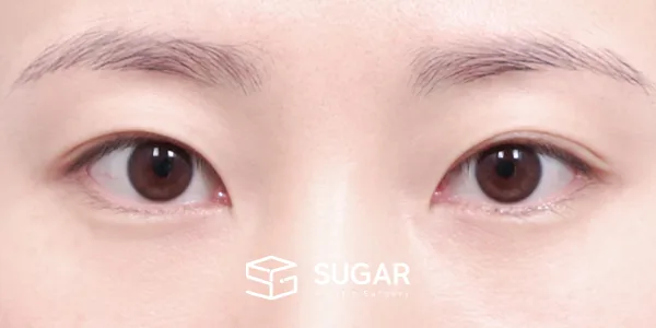 슈가성형외과 첫) 자연유착 전후사진 - 수술 전