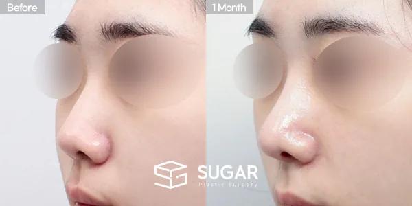 슈가성형외과 첫) 콧대+비중격연장+짧은코+코선반교정+귀연골 전후사진 - 45도 수술 전후 비교