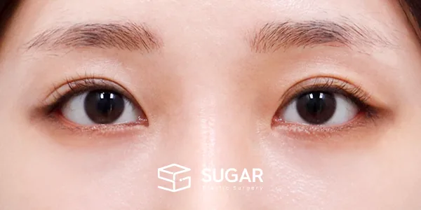 슈가성형외과 첫) 뒤밑트임 전후사진 - 수술 후