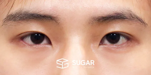슈가성형외과 첫) 윗트임 + 뒤밑트임 전후사진 - 수술 후